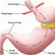 Bariatric Surgery Shown To Reduce Diabetes Bariatric Surgery Shown To Reduce Diabetes