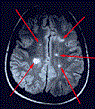 Seasonal Variation In Multiple Sclerosis Lesions Uncovered